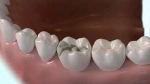 Traitement d'une carie par inlay/onlay