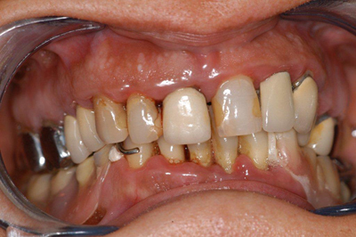 Traitement gingival avant