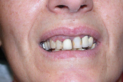 Traitement gingival après