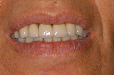 Pose d'implants avant