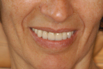 Pose d'implants après