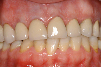 Les dents après les traitements