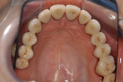 Les dents après les traitements dentaires