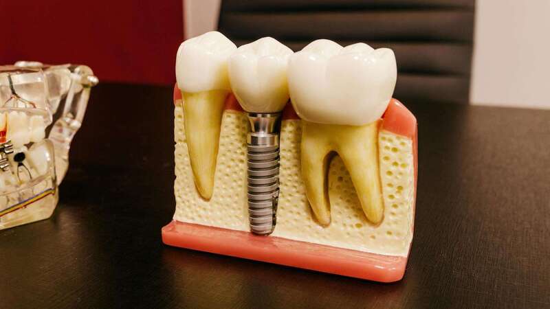 L’implant dentaire