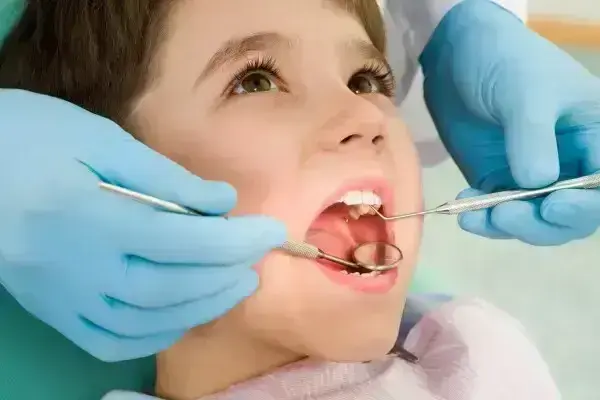Comment se forme une carie ? Comprendre le mécanisme pour mieux la prévenir