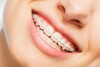 Comparatif avant après éclaircissement dentaire sourire éclatant