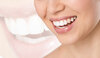 Sourire féminin avant après blanchiment dents naturelles éclatantes