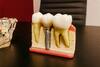 Femme souriante tenant gouttière orthodontie transparente