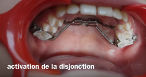 Activation de la disjonction