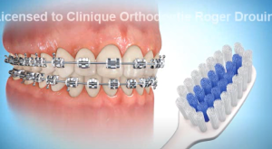 Brossage avec des bagues