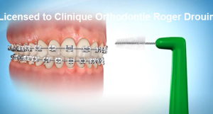Brossage entre les boîtiers orthodontiques