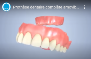 Prothèse dentaire complète amovible (dentier)