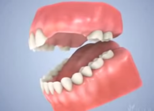 Prothèse dentaire partielle (partiel)