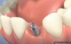 Couronne sur implant dentaire