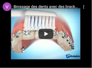 Brossage des dents avec des brackets