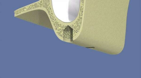 Le comblement de sinus par abord crestal