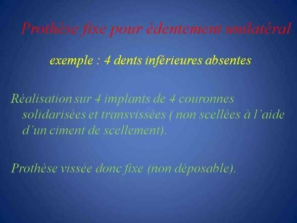 Prothèse fixe transvissée