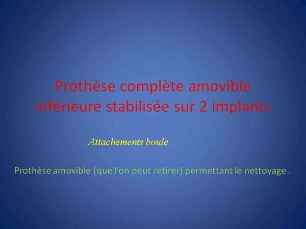 Prothèse complète amovible inférieure stabilisée sur 2 implants (Boule)
