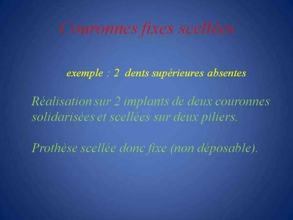 Couronnes fixes scellées