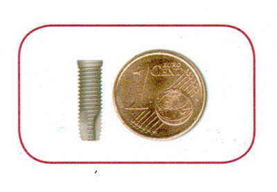 Implantologie : remplacement d'une dent