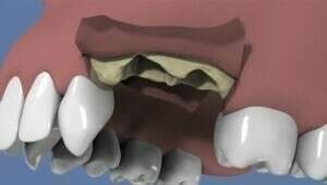 Extraction et comblement osseux