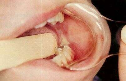 Complication des extrations des dents de sagesse