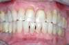 Blanchiment dentaire cas 4 - après