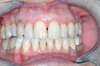 Blanchiment dentaire cas 5 - après