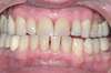 Blanchiment dentaire cas 8 - avant