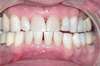 Blanchiment dentaire cas 8 - après