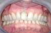 Blanchiment dentaire cas 9 - après