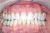 Blanchiment dentaire cas 10 - après