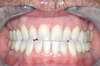 Blanchiment dentaire cas 11 - après