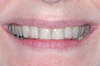 Blanchiment dentaire cas 12 - avant