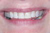 Blanchiment dentaire cas 12 - après