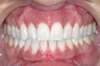 Blanchiment dentaire cas 13 - après