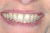 Blanchiment dentaire cas 14 - avant