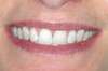 Blanchiment dentaire cas 14 - après