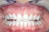 Blanchiment dentaire cas 15 - après