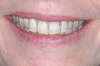Blanchiment dentaire cas 16 - avant