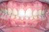 Blanchiment dentaire cas 17 - après