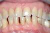 Facettes dentaires cas 3 - avant