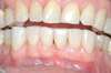 Facettes dentaires cas 3 - après