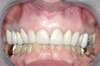 Facettes dentaires cas 4 - après