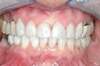 Facettes dentaires cas 5 - après
