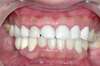 Facettes dentaires cas 23 - avant