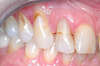 Facettes dentaires cas 29 - avant