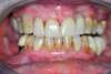 Traitement des dents cas 2 - avant