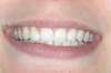 Facettes dentaires cas 13 - après