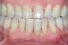 Facettes dentaires cas 15 - après